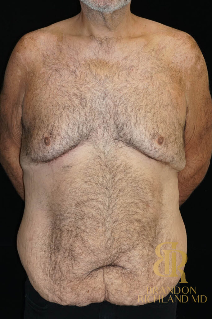 Tummy Tuck Before, Patient 43, view 1 — Dr. Brandon Richland, Newport Beach
