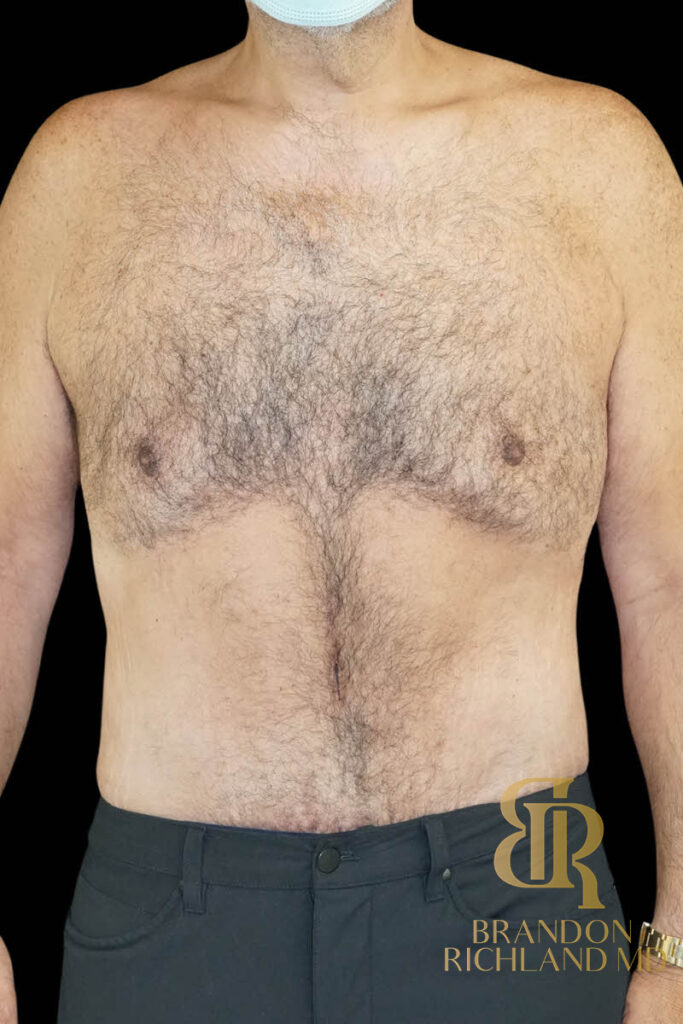 Tummy Tuck After, Patient 43, view 1 — Dr. Brandon Richland, Newport Beach