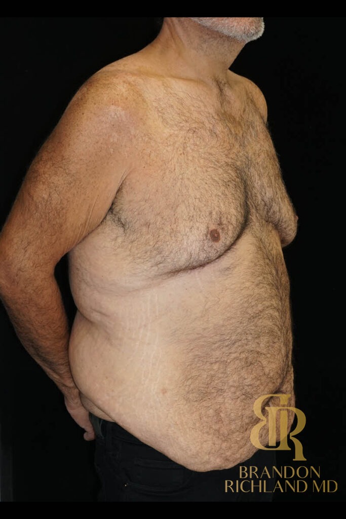 Tummy Tuck Before, Patient 43, view 2 — Dr. Brandon Richland, Newport Beach