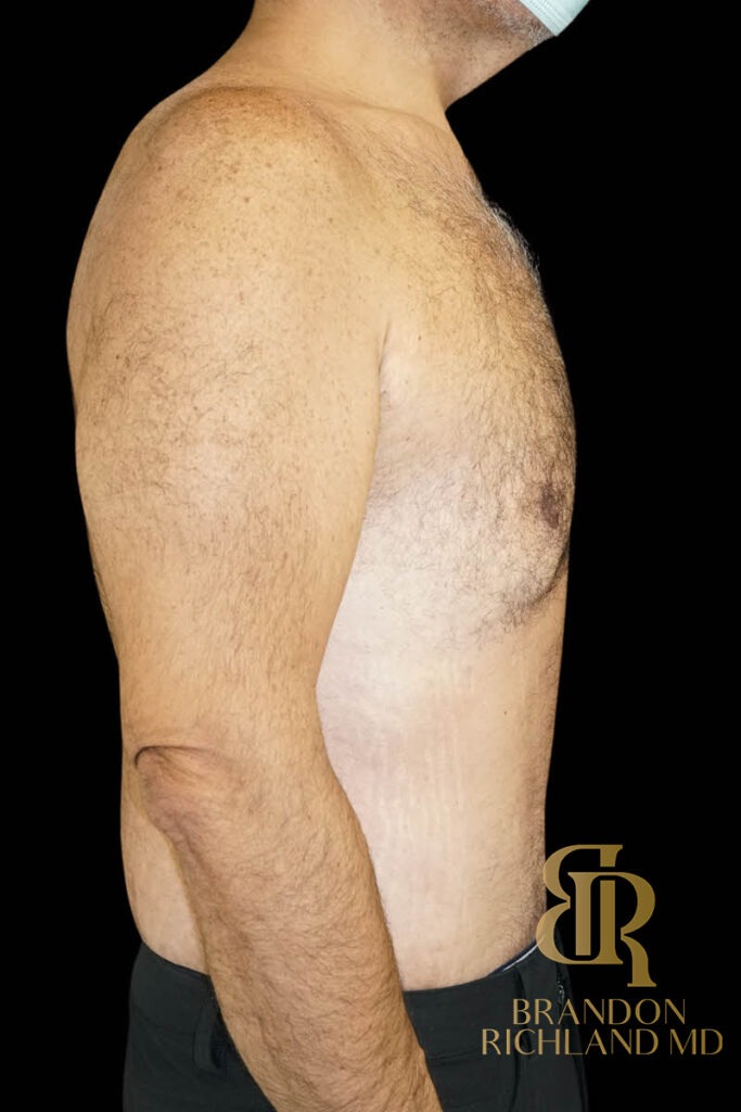 Tummy Tuck After, Patient 43, view 3 — Dr. Brandon Richland, Newport Beach
