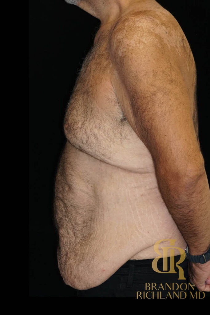 Tummy Tuck Before, Patient 43, view 5 — Dr. Brandon Richland, Newport Beach