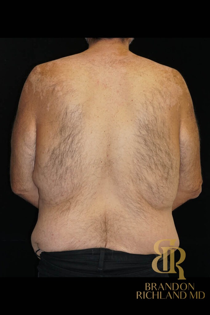 Tummy Tuck Before, Patient 43, view 6 — Dr. Brandon Richland, Newport Beach