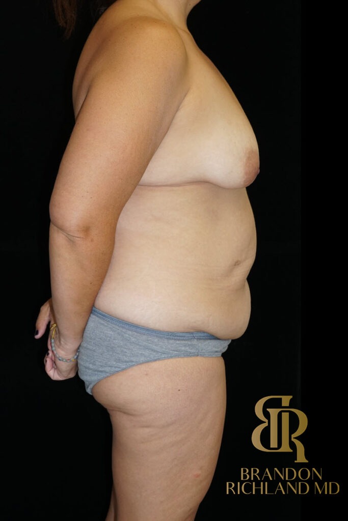 Tummy Tuck Before, Patient 44, view 3 — Dr. Brandon Richland, Newport Beach