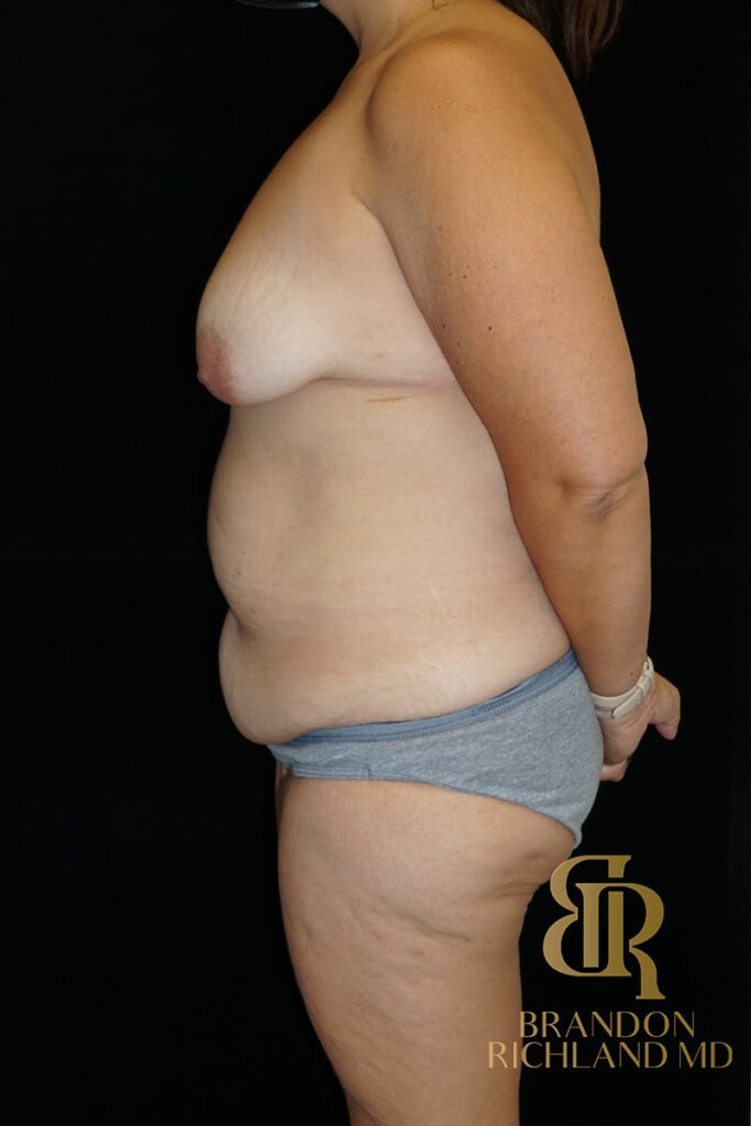 Tummy Tuck Before, Patient 44, view 5 — Dr. Brandon Richland, Newport Beach