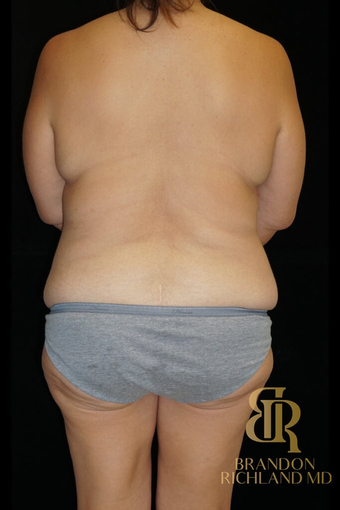 Tummy Tuck Before, Patient 44, view 6 — Dr. Brandon Richland, Newport Beach