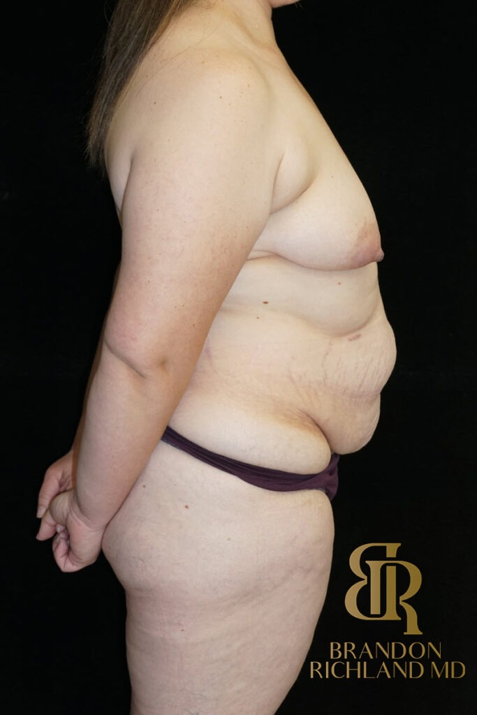 Tummy Tuck Before, Patient 45, view 3 — Dr. Brandon Richland, Newport Beach