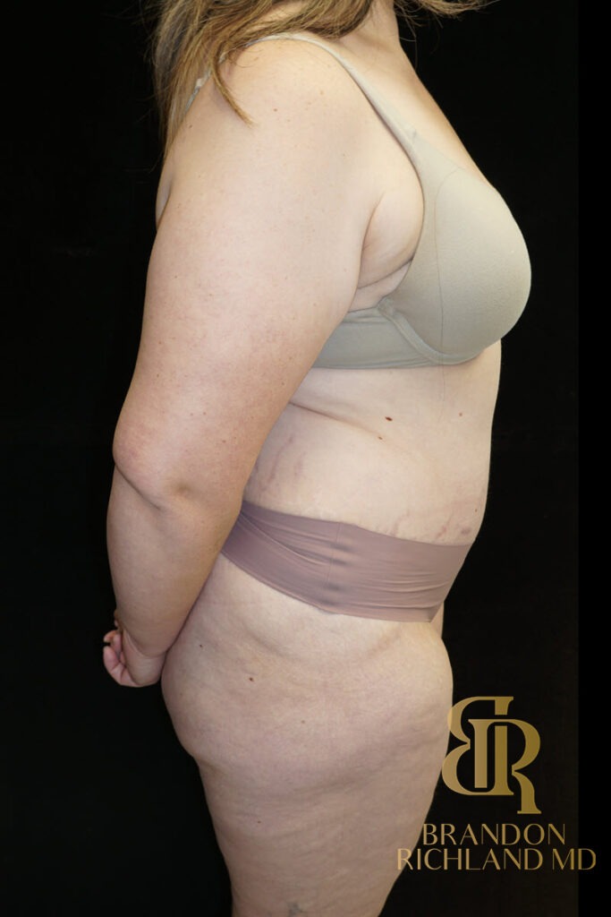 Tummy Tuck After, Patient 45, view 3 — Dr. Brandon Richland, Newport Beach