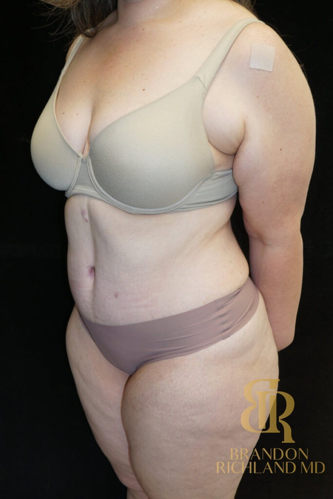 Tummy Tuck After, Patient 45, view 4 — Dr. Brandon Richland, Newport Beach