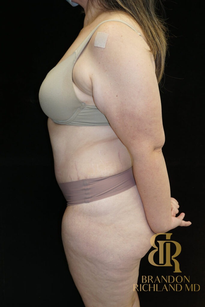 Tummy Tuck After, Patient 45, view 5 — Dr. Brandon Richland, Newport Beach