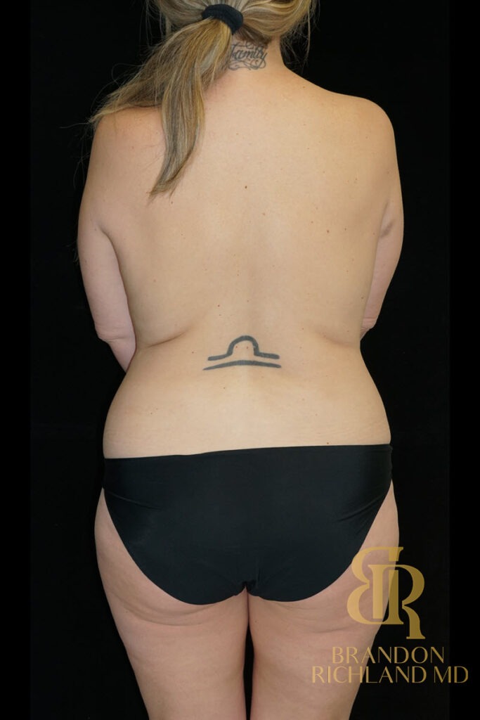 Tummy Tuck Before, Patient 47, view 6 — Dr. Brandon Richland, Newport Beach
