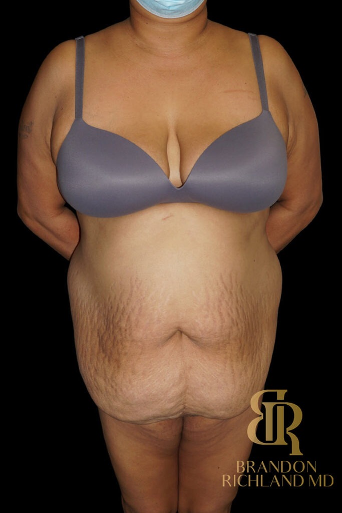 Tummy Tuck Before, Patient 48, view 1 — Dr. Brandon Richland, Newport Beach
