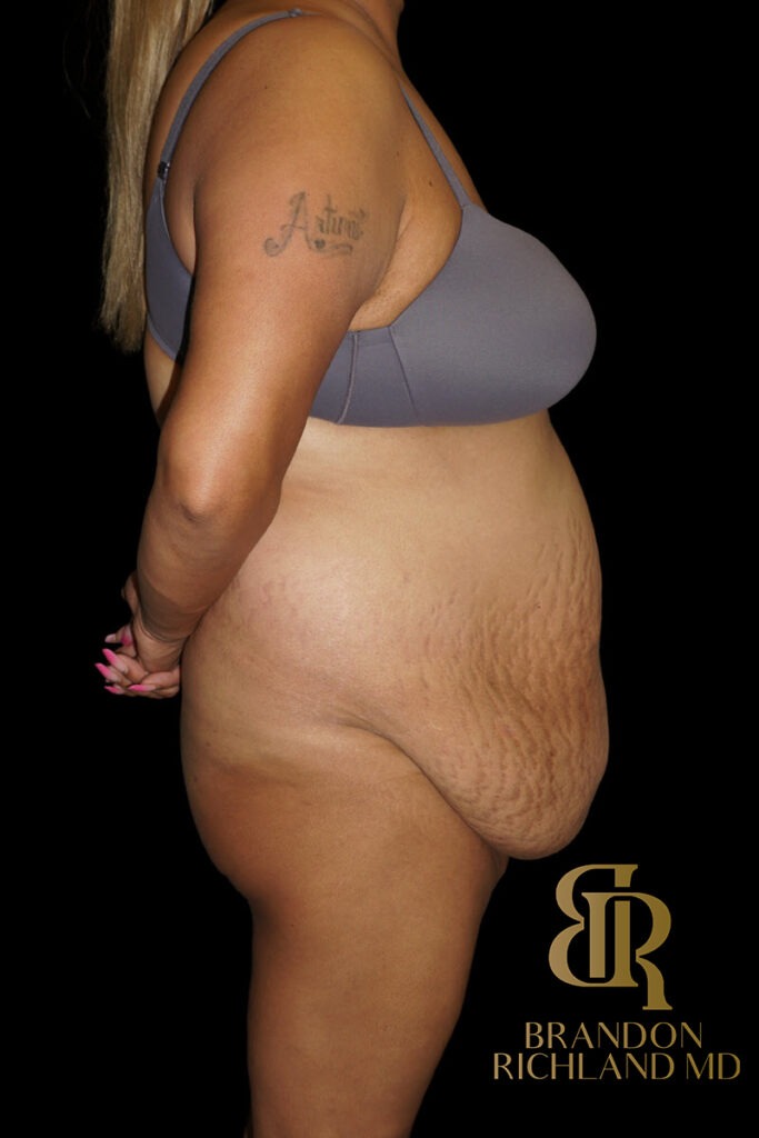 Tummy Tuck Before, Patient 48, view 3 — Dr. Brandon Richland, Newport Beach