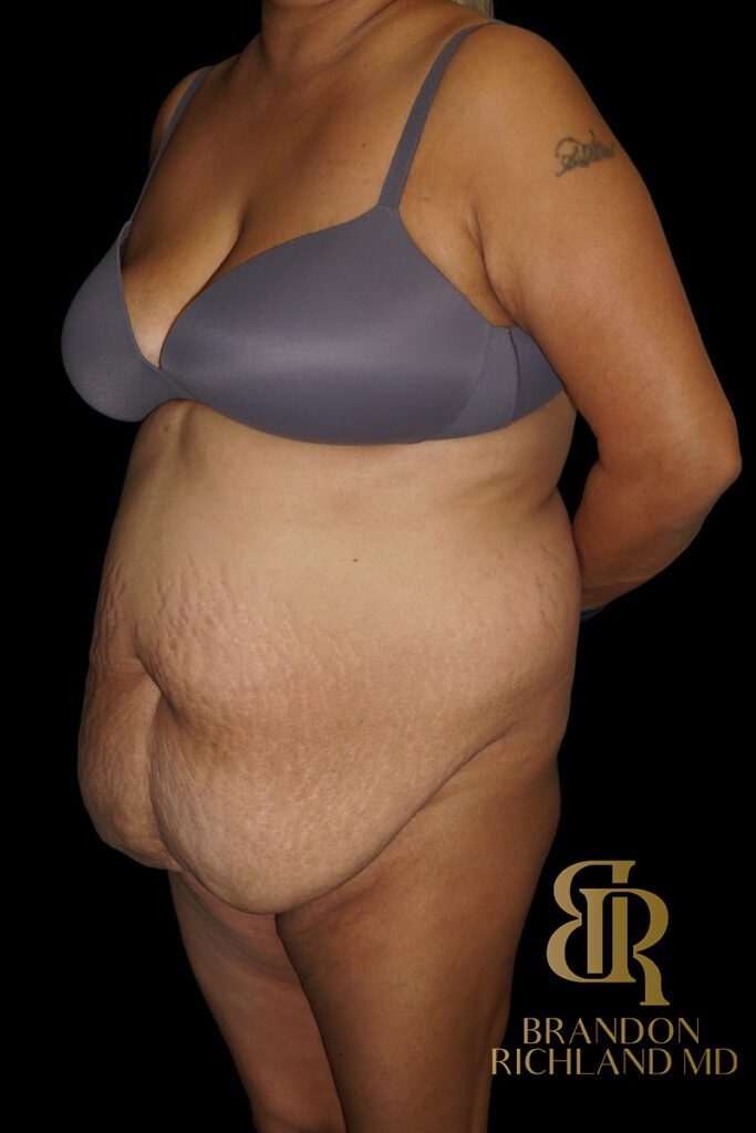 Tummy Tuck Before, Patient 48, view 4 — Dr. Brandon Richland, Newport Beach