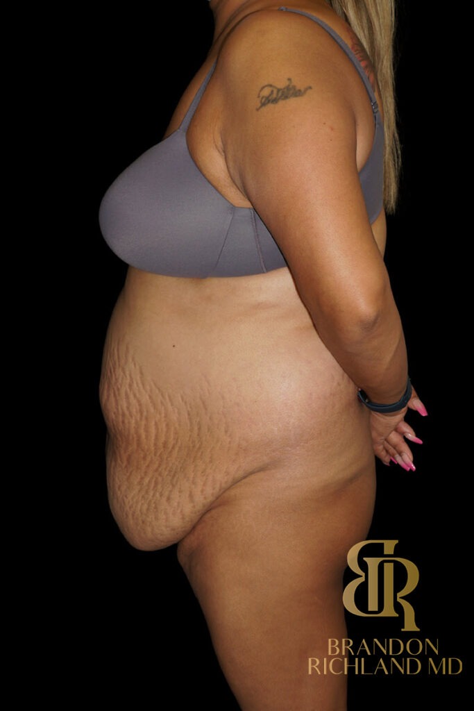 Tummy Tuck Before, Patient 48, view 5 — Dr. Brandon Richland, Newport Beach
