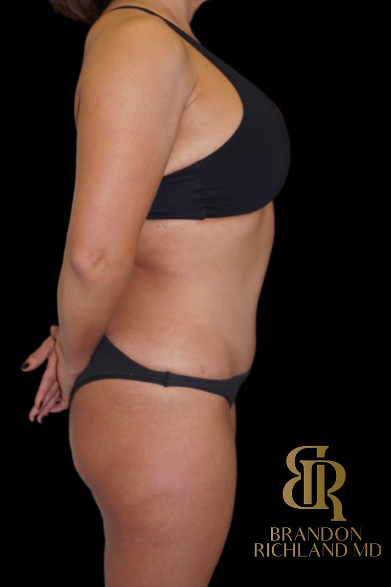 Tummy Tuck before and after, Patient 49 — Dr. Brandon Richland, Newport Beach