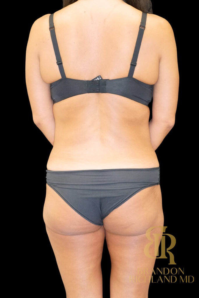Tummy Tuck Before, Patient 49, view 6 — Dr. Brandon Richland, Newport Beach