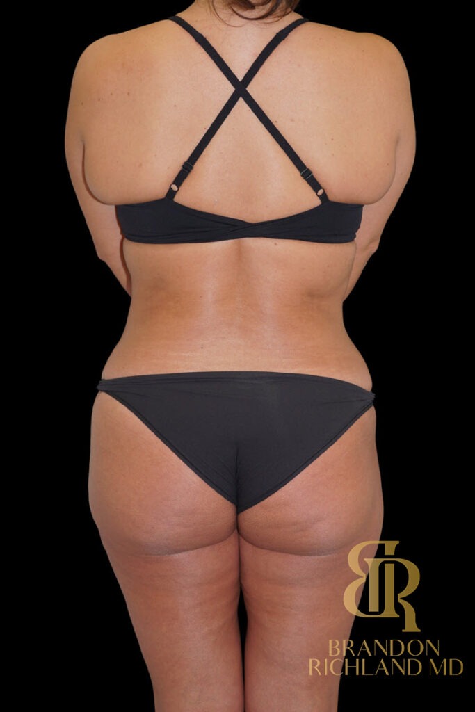 Tummy Tuck After, Patient 49, view 6 — Dr. Brandon Richland, Newport Beach