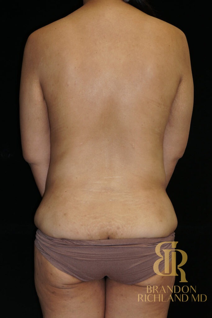 Tummy Tuck Before, Patient 51, view 6 — Dr. Brandon Richland, Newport Beach