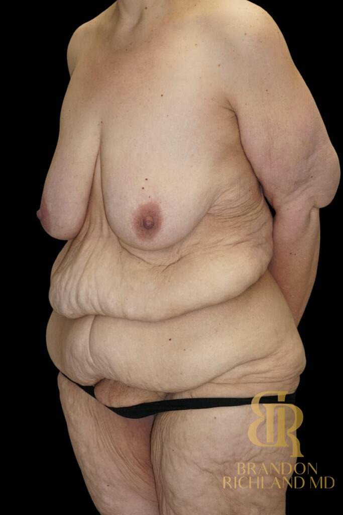 Tummy Tuck Before, Patient 52, view 4 — Dr. Brandon Richland, Newport Beach