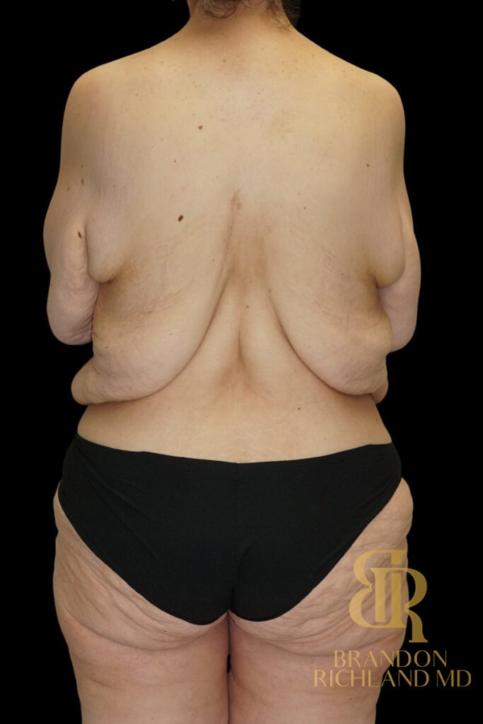 Tummy Tuck Before, Patient 52, view 6 — Dr. Brandon Richland, Newport Beach