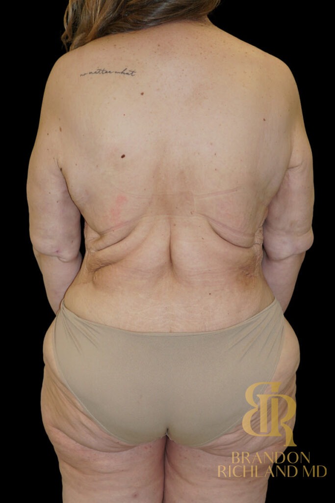Tummy Tuck After, Patient 52, view 6 — Dr. Brandon Richland, Newport Beach