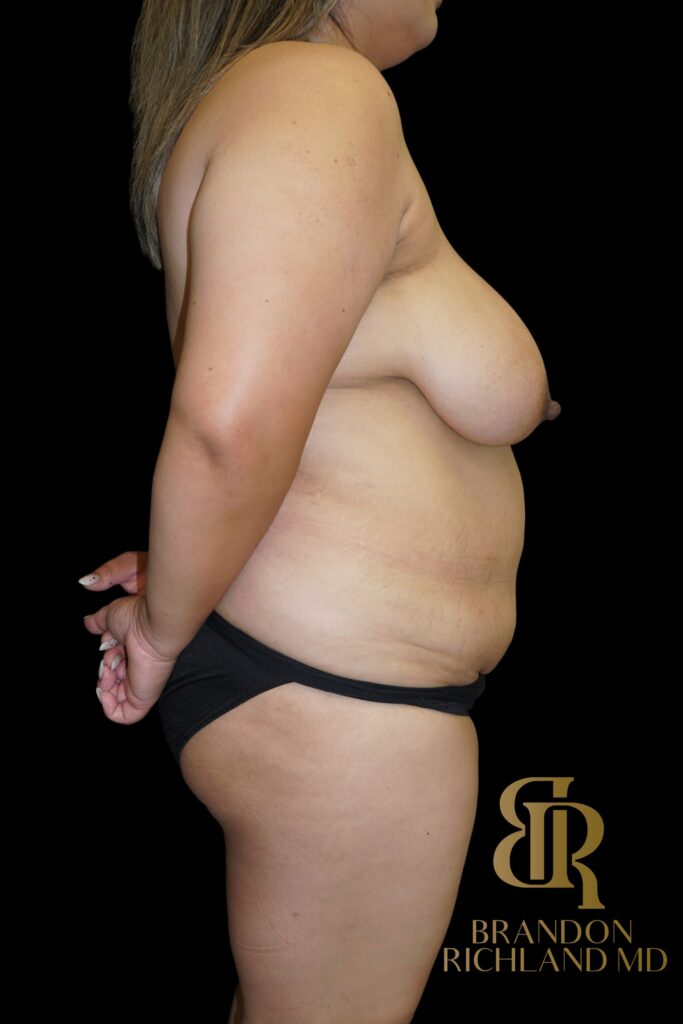 Tummy Tuck Before, Patient 53, view 3 — Dr. Brandon Richland, Newport Beach