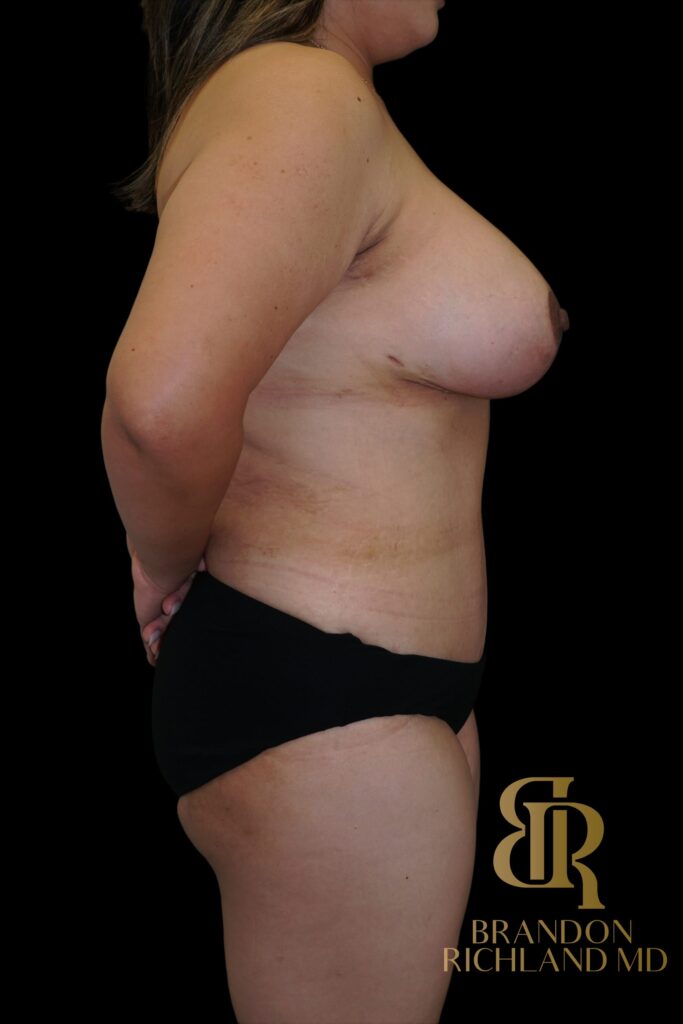Tummy Tuck After, Patient 53, view 3 — Dr. Brandon Richland, Newport Beach