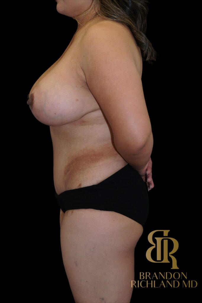 Tummy Tuck After, Patient 53, view 5 — Dr. Brandon Richland, Newport Beach