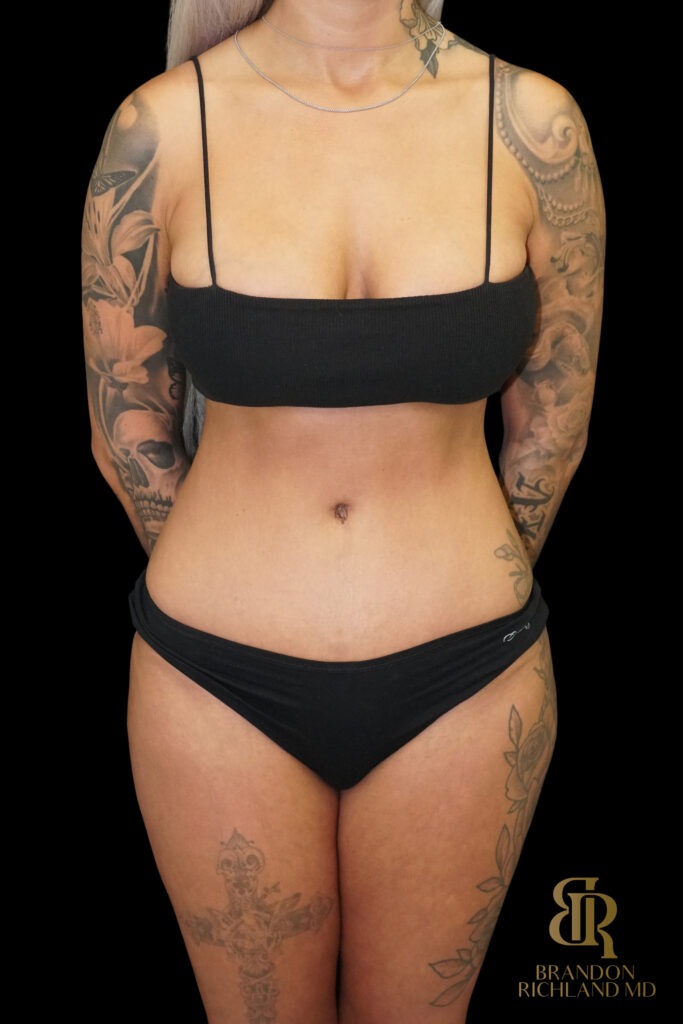 Tummy Tuck After, Case #86949, view 1 — Dr. Brandon Richland, Newport Beach