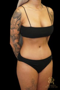 Tummy Tuck before and after, Case #86949 — Dr. Brandon Richland, Newport Beach