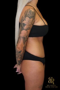 Tummy Tuck before and after, Case #86949 — Dr. Brandon Richland, Newport Beach