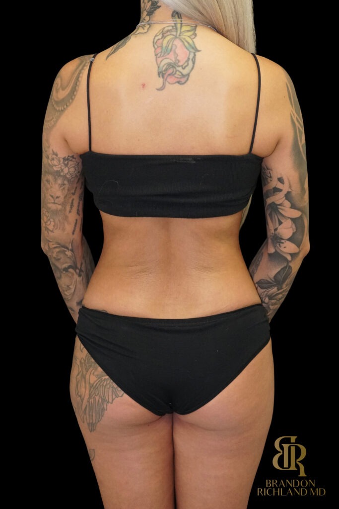 Tummy Tuck After, Case #86949, view 6 — Dr. Brandon Richland, Newport Beach