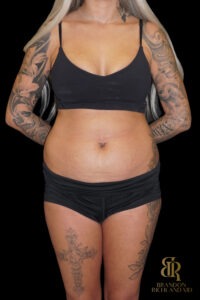 Tummy Tuck before and after, Case #86949 — Dr. Brandon Richland, Newport Beach