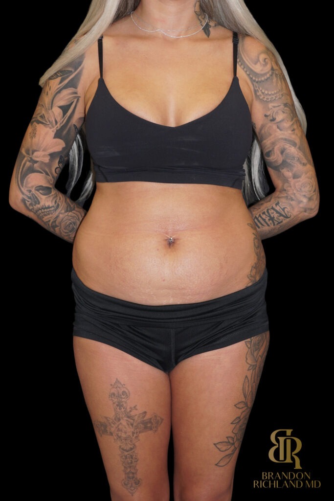 Tummy Tuck Before, Case #86949, view 1 — Dr. Brandon Richland, Newport Beach