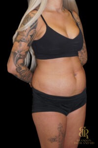 Tummy Tuck before and after, Case #86949 — Dr. Brandon Richland, Newport Beach