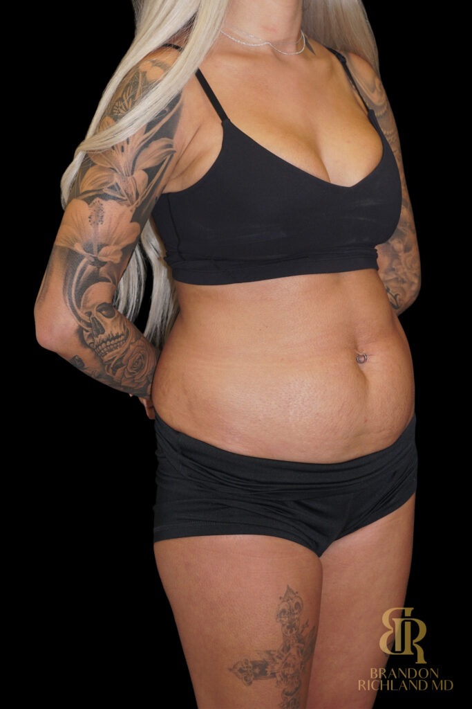 Tummy Tuck Before, Case #86949, view 2 — Dr. Brandon Richland, Newport Beach