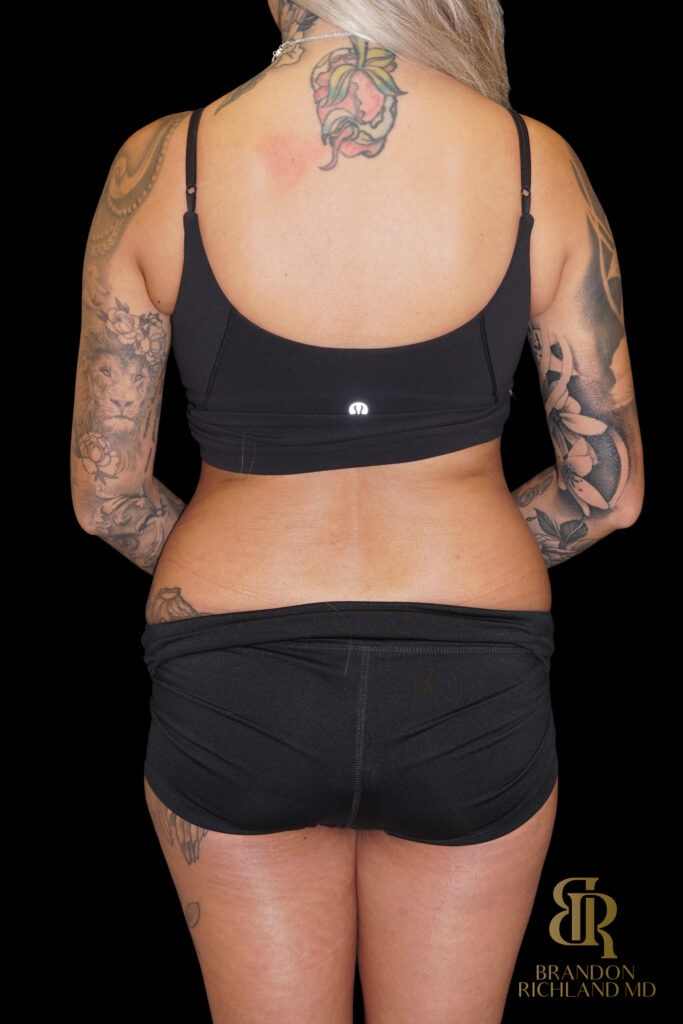 Tummy Tuck Before, Case #86949, view 6 — Dr. Brandon Richland, Newport Beach