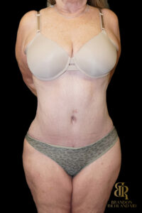 Tummy Tuck before and after, Case #96614 — Dr. Brandon Richland, Newport Beach