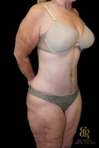 Tummy Tuck before and after, Case #96614 — Dr. Brandon Richland, Newport Beach
