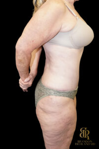 Tummy Tuck before and after, Case #96614 — Dr. Brandon Richland, Newport Beach