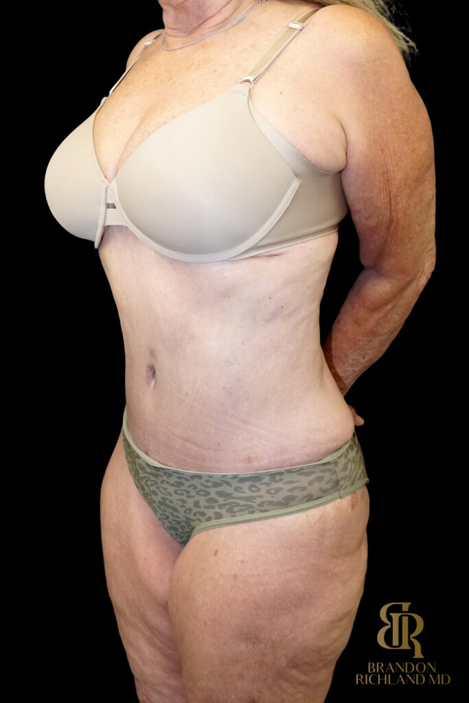 Tummy Tuck After, Case #96614, view 4 — Dr. Brandon Richland, Newport Beach