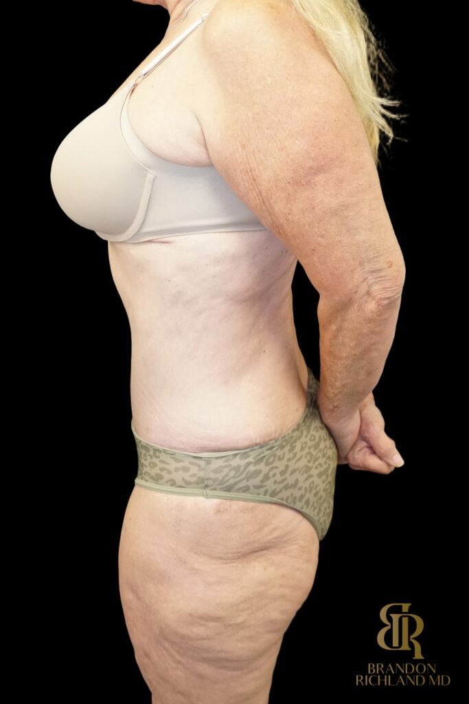Tummy Tuck After, Case #96614, view 5 — Dr. Brandon Richland, Newport Beach