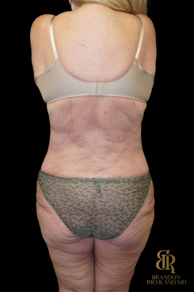 Tummy Tuck After, Case #96614, view 6 — Dr. Brandon Richland, Newport Beach