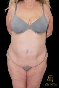 Tummy Tuck before and after, Case #96614 — Dr. Brandon Richland, Newport Beach