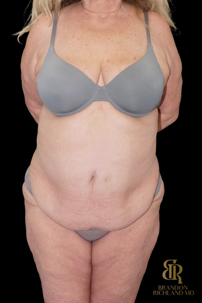 Tummy Tuck Before, Case #96614, view 1 — Dr. Brandon Richland, Newport Beach