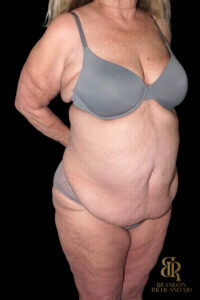 Tummy Tuck before and after, Case #96614 — Dr. Brandon Richland, Newport Beach