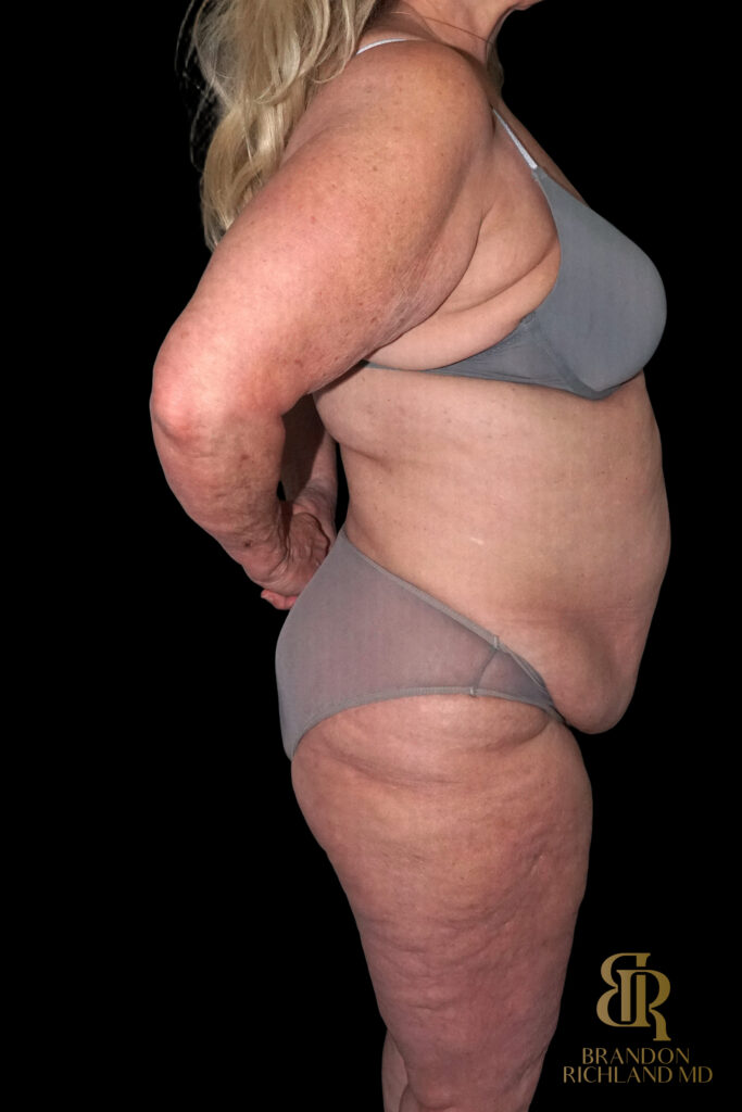 Tummy Tuck Before, Case #96614, view 3 — Dr. Brandon Richland, Newport Beach