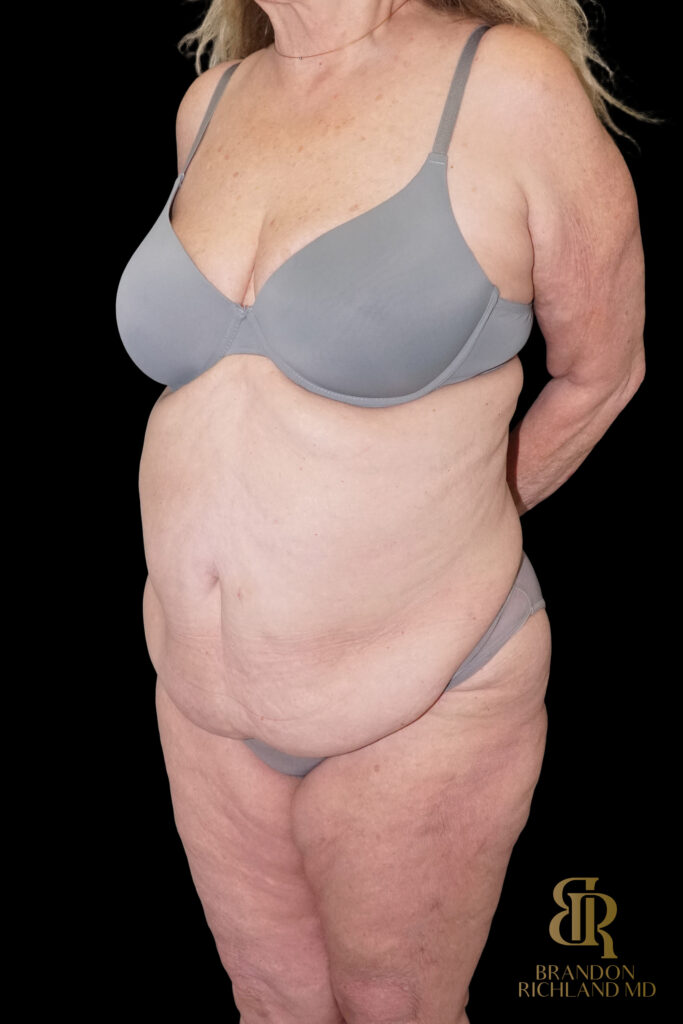 Tummy Tuck Before, Case #96614, view 4 — Dr. Brandon Richland, Newport Beach