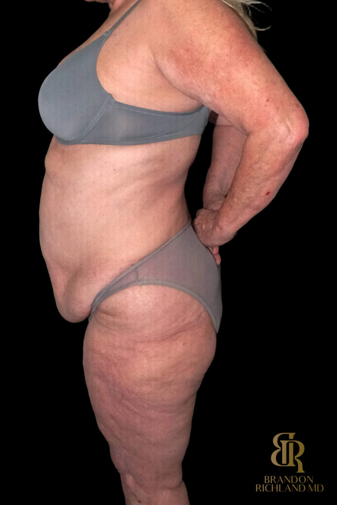 Tummy Tuck Before, Case #96614, view 5 — Dr. Brandon Richland, Newport Beach