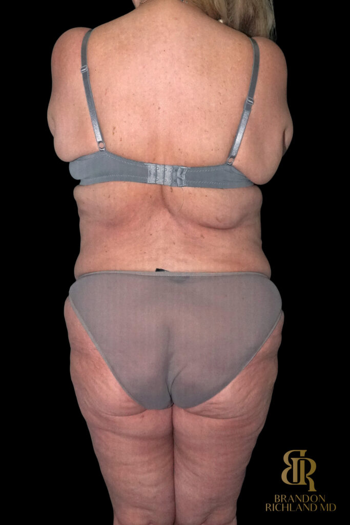 Tummy Tuck Before, Case #96614, view 6 — Dr. Brandon Richland, Newport Beach